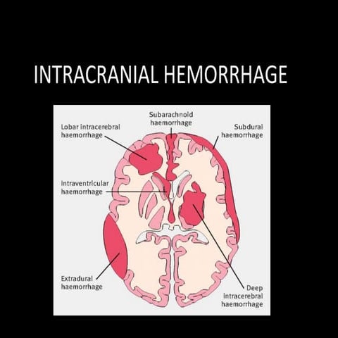Intracranial hemorrhage- shruthi s jayaraj, calicut medical college