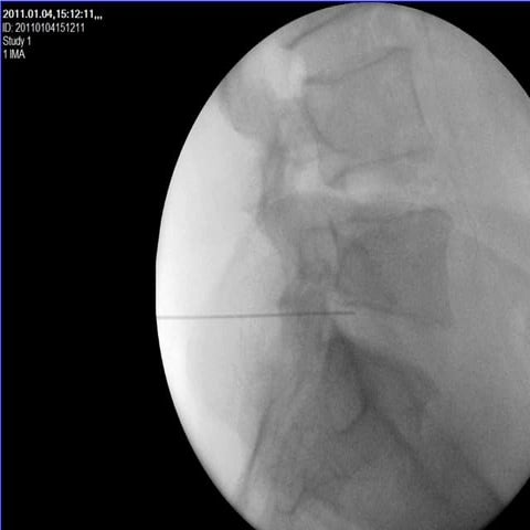 Blocked epidural catheter | DOC