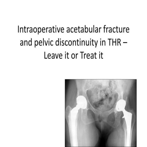 Intraoperative acetabular fracture and pelvic discontinuity in thr