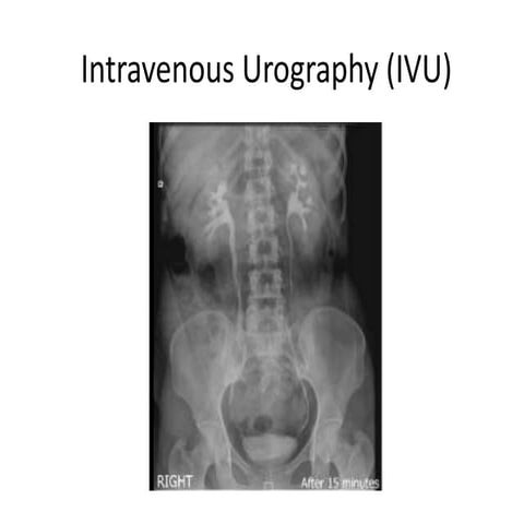 Intravenous Urography (IVU)., radiological procedure | PPTX | Digestive ...