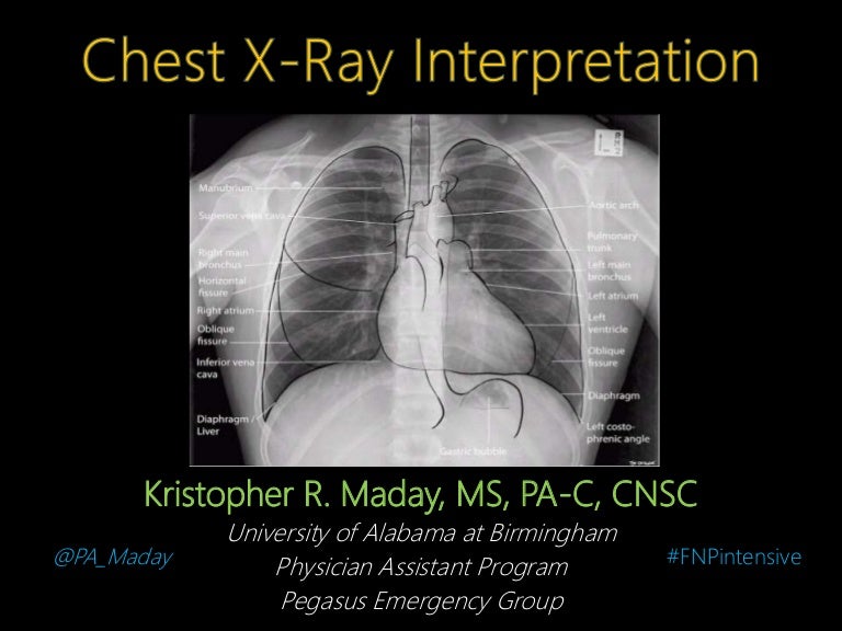 Introduction to Chest XRay Interpretation