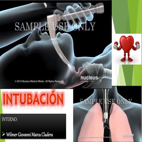 INTUBACIÓN - SECUENCIA DE INTUBACIÓN RAPIDA