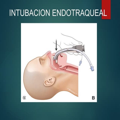 Inicio y secuencia de intubacion en pacientes quirurgicos | PPTX