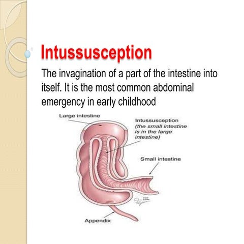 Intussusception | PPTX