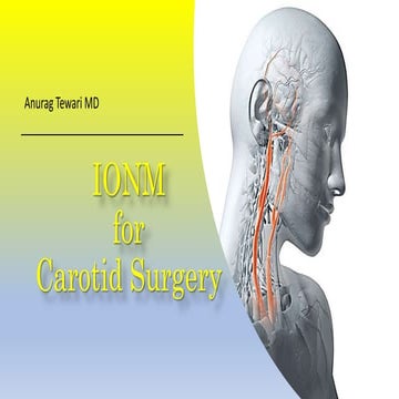 IONM for Carotid Surgery & Carotidendartectomy