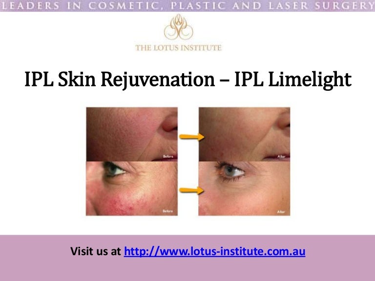 IPL Skin Rejuvenation Treatments IPL Limelight Laser Genesis