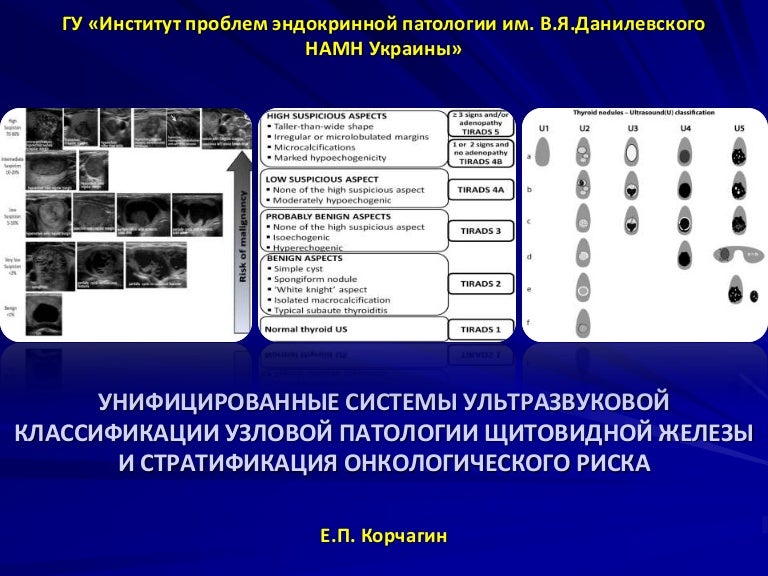 Ti rads что это значит. Классификация Tirads щитовидная железа. Tirads 4 щитовидная железа. Классификация узлов щитовидной. Узлы в щитовидной железе классификация.