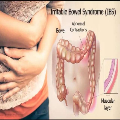 Irritable  bowel syndrome