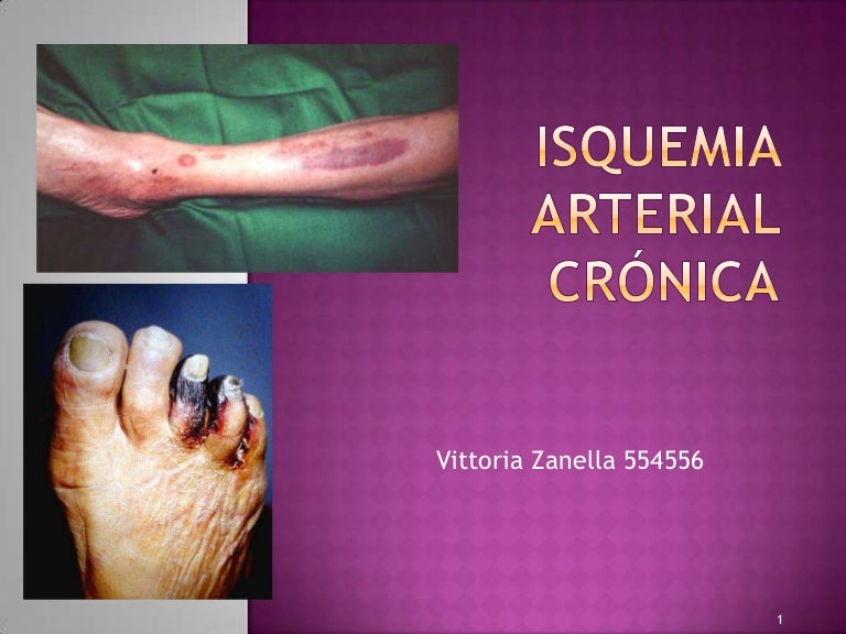 isquemia arterial