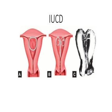 IUCD.presentation........................
