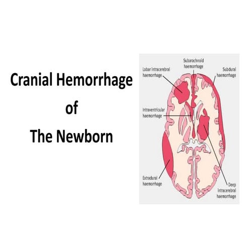 Cranial Hemorrhage  of  The Newborn 