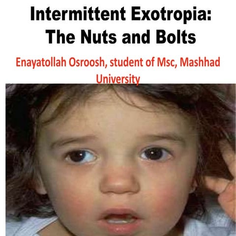 Intermittent exotropia