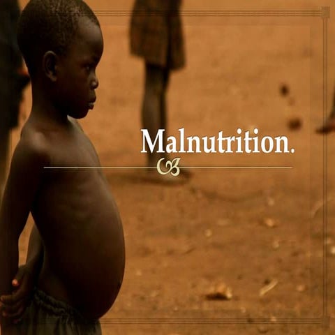 malnutrition classification and severe malnutrition management