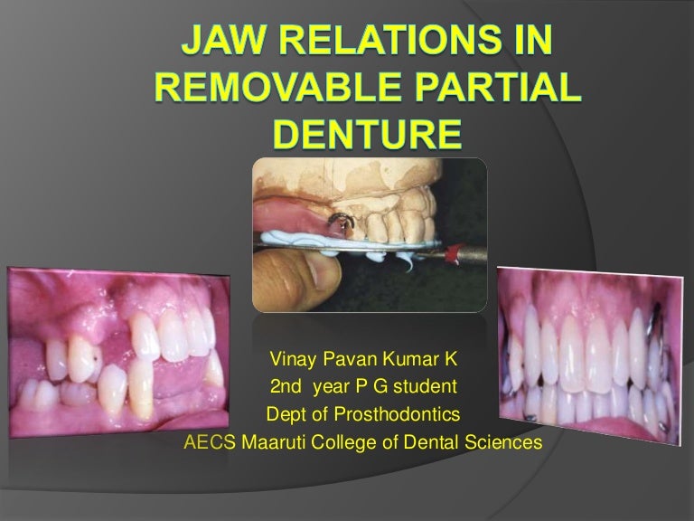 Jaw relation in rpd