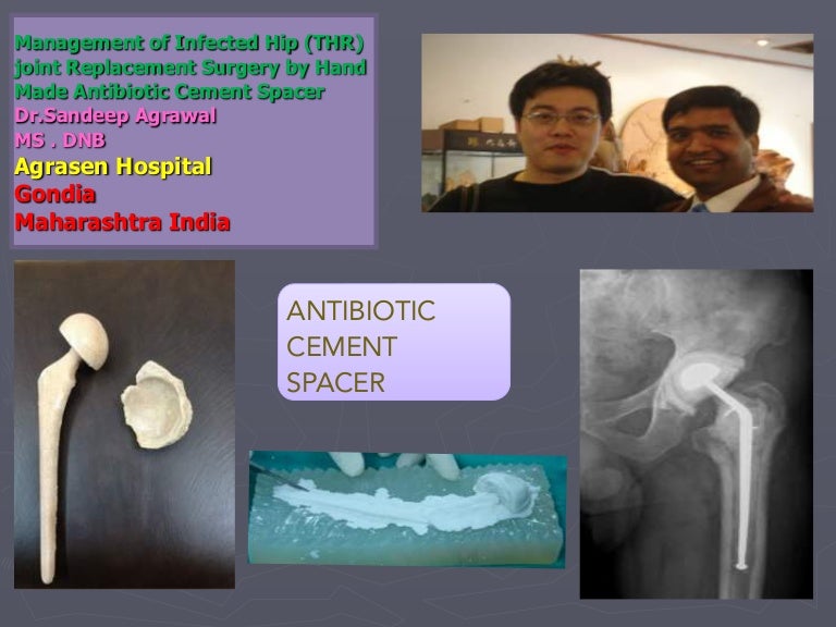 Antibiotic Cement Spacer for Infected Hip Joint Replacement (THR) Sur…