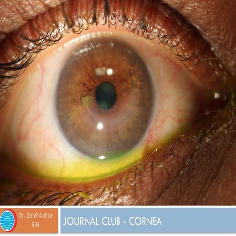 Journal Club Corneal Intrastromal Ring Segmentspptx