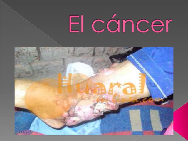 Juan el cancer