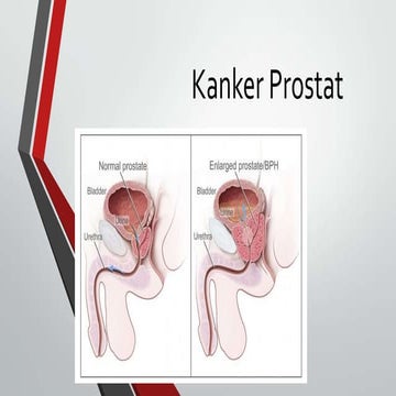 Kanker prostat