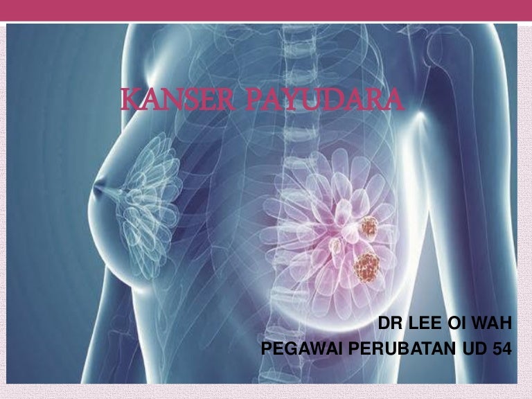 Gambar Kanser Payudara Kanser Payudara