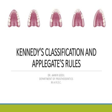 Kennedy’s Classification in Cast Partial Denture