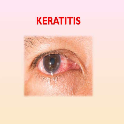 Keratitis, also known as corneal ulcer, is an inflammation of the cornea, the...