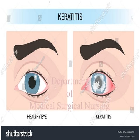 KERATITIS AND ITS MANAGEMENT........pptx