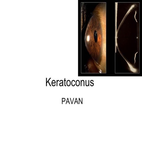 Keratoconus