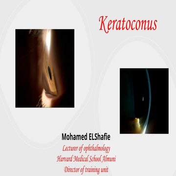 Diagnosis and management of Keratoconus cases