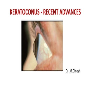 Keratoconus f dinesh