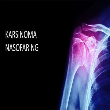 KARSINOMA NASOFARING SERTA TATALAKSANANYA | PPT