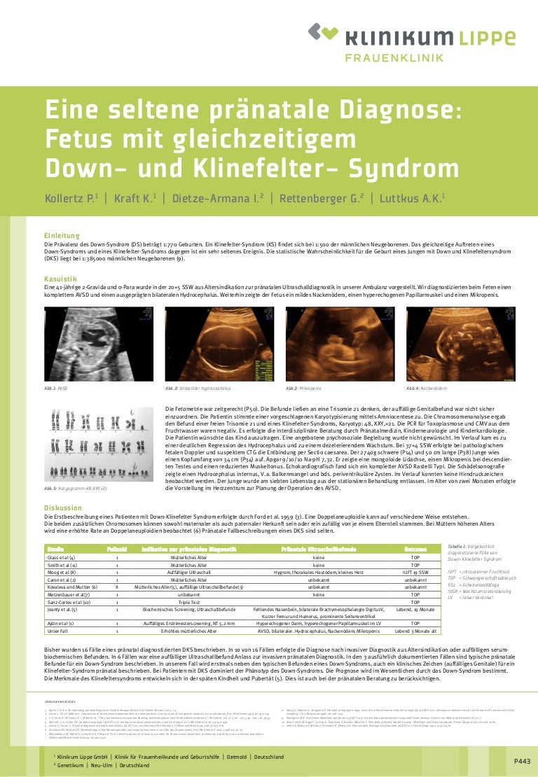 Eine Seltene Pranatale Diagnose Fetus Mit Gleichzeitigem Down Und K