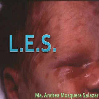 Lupus Eritematoso Sistémico en edad...