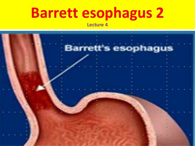 L4 barrett esophagus 2