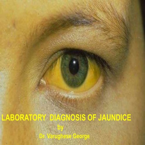 Laboratory Diagnosis of Jaundice