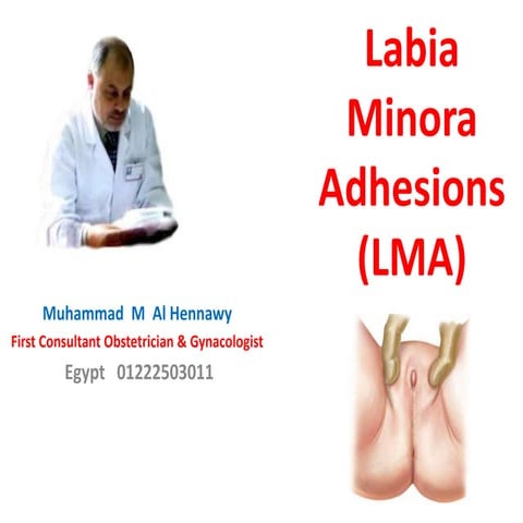 Labial adhesion | PPTX