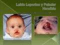 Labio leporino y paladar hendido