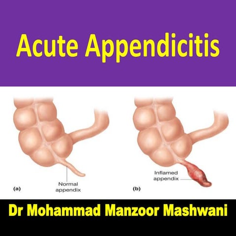 L acute appendicitis