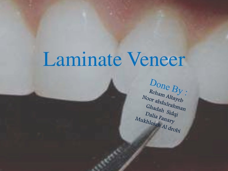 Laminate veneer.