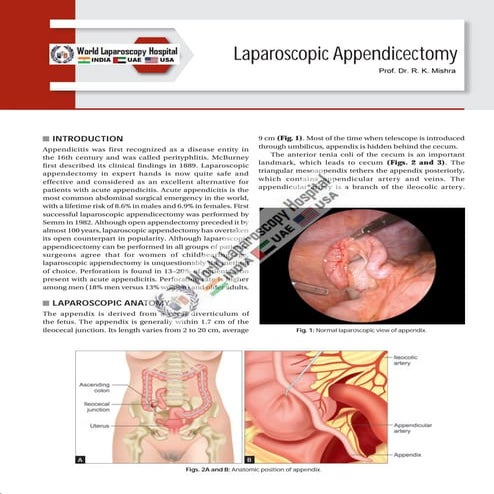 Laparoscopic Appendicectomy at World Laparoscopy Hospital