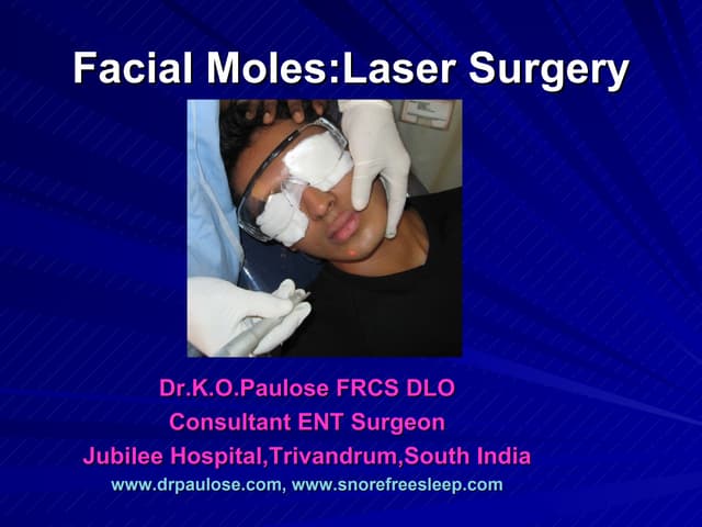 Laser Surgery Facial Mole:By Dr.K.O...