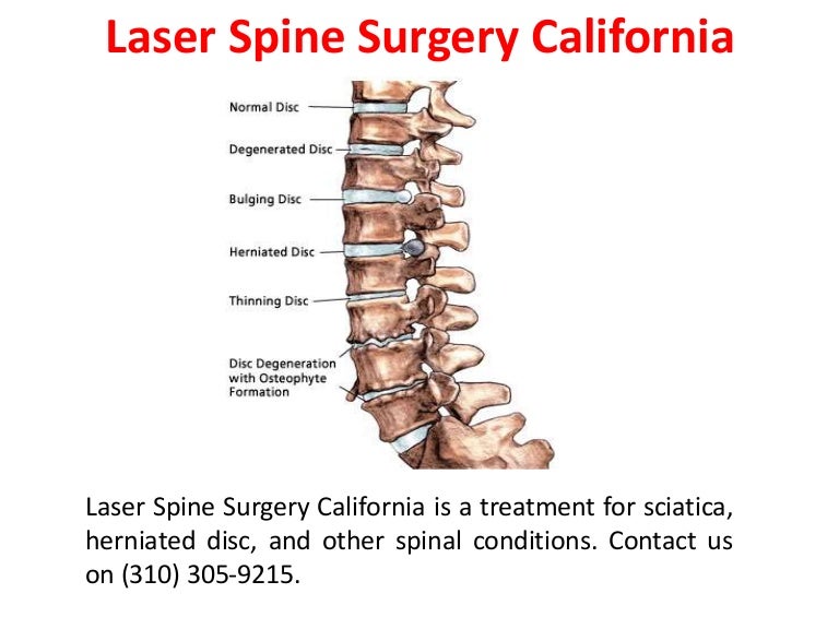 Disc Laser Spine Surgery
