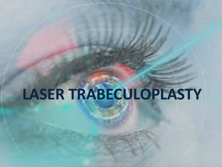 Laser trabeculoplasty