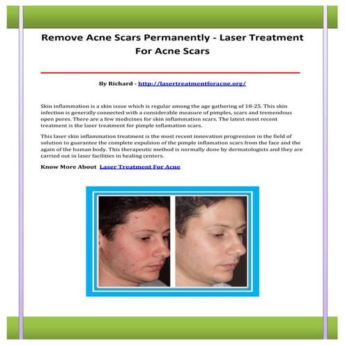 Laser treatment for acne scars