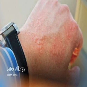 Latex Allergy