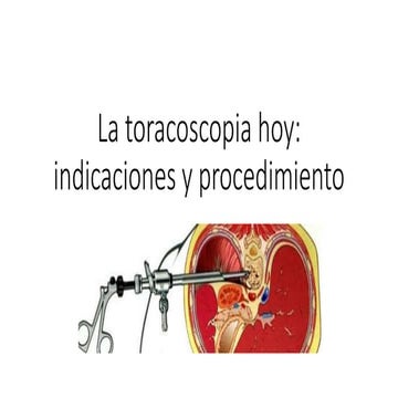 La toracoscopia hoy | PPTX