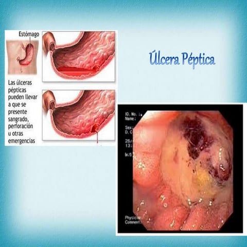 úLcera péptica