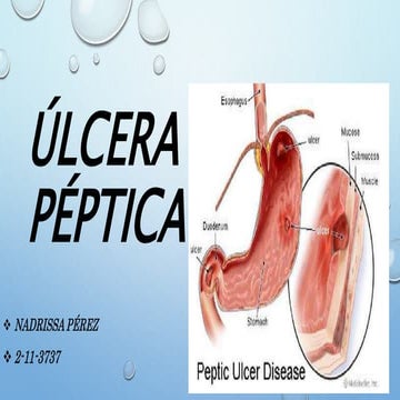 Ulcera Peptica