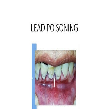 LEAD POISONING (1).pptx.................. | PPTX