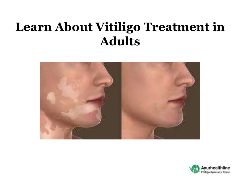 vitiligo treatment