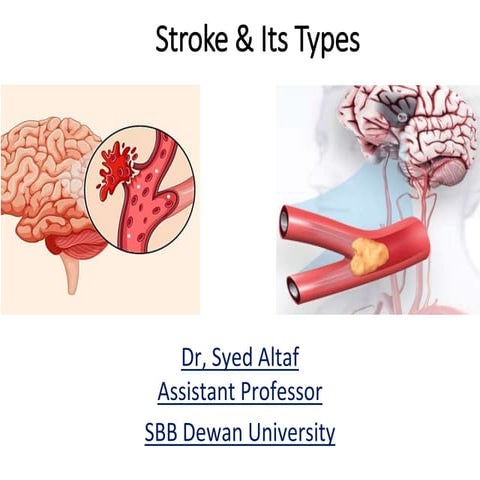 Stroke & its Management ( Medicine) 